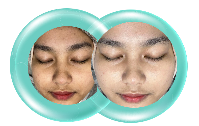 CEL Oxygenic E-Before After 3