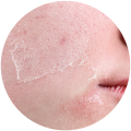 Dry & Dehydrated Skin
