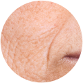 Fine Lines & Early Aging Signs